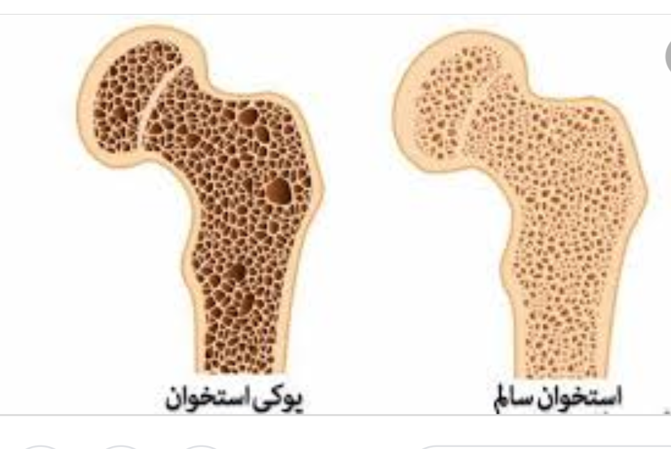 مقایسه استخوان مبتلا به پوکی با سالم